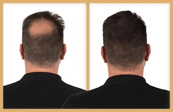 Antes y Después de usar Kapilab richar 2