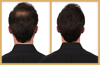 Antes y Después de usar Kapilab simon 2